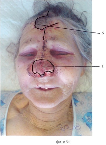 Способ восстановления наружного носа при субтотальных дефектах (патент 2452403)