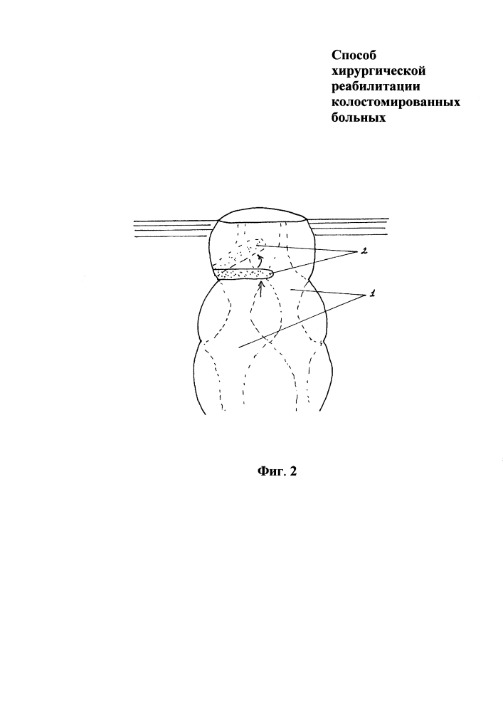 Способ хирургической реабилитации колостомированных больных (патент 2618202)