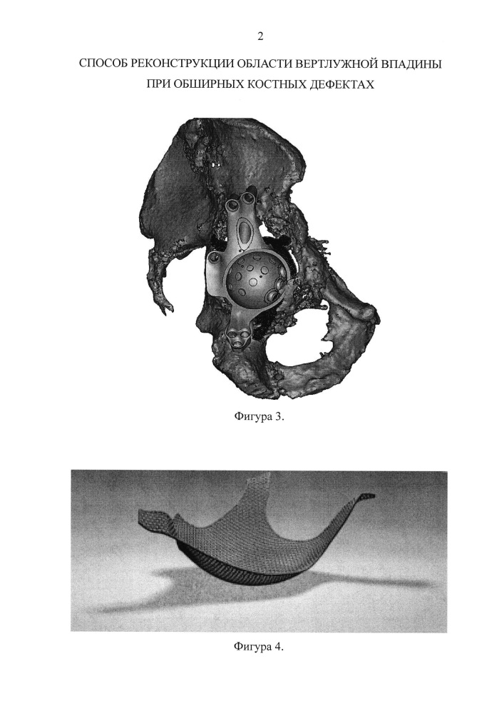 Способ реконструкции области вертлужной впадины при обширных костных дефектах (патент 2656522)