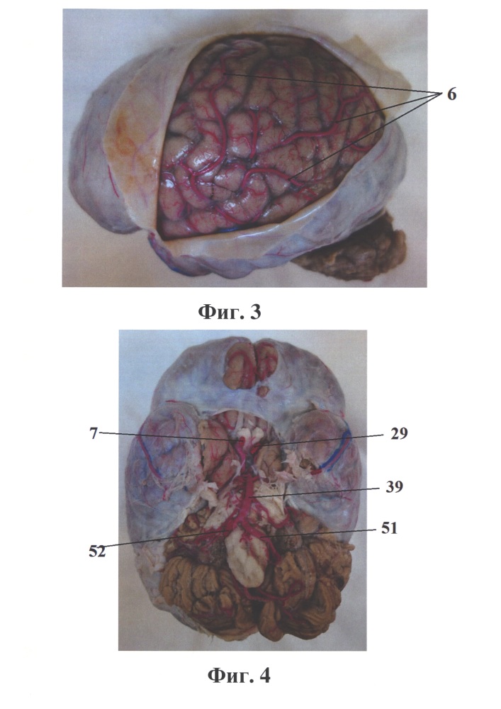 Способ визуализации артериальных и венозных сосудов основания черепа и головного мозга человека для их топографо-анатомического исследования (патент 2621419)