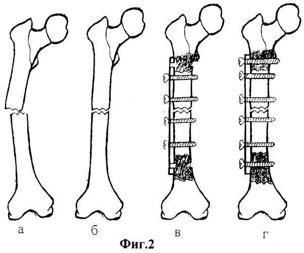 Способ лечения переломов трубчатых костей при выраженном остеопорозе (патент 2494694)