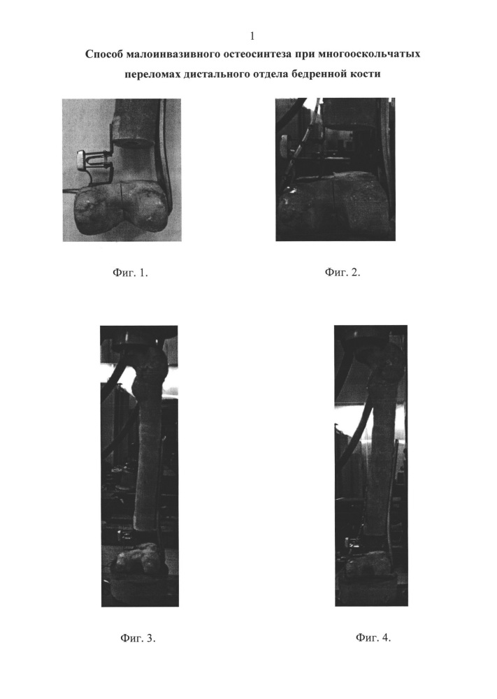 Способ малоинвазивного остеосинтеза при многооскольчатых переломах дистального отдела бедренной кости (патент 2665158)