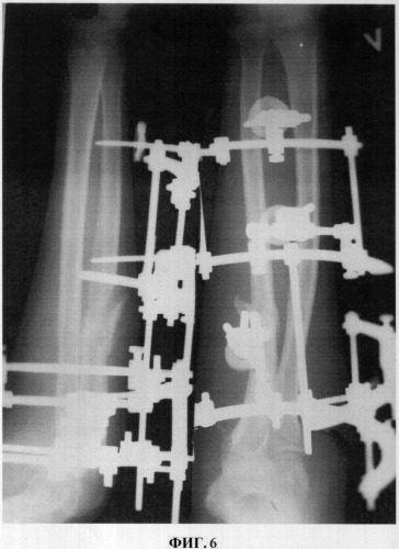 Способ чрескостного остеосинтеза переломовывихов костей предплечья типа монтеджа и аппарат для его осуществления (патент 2324448)