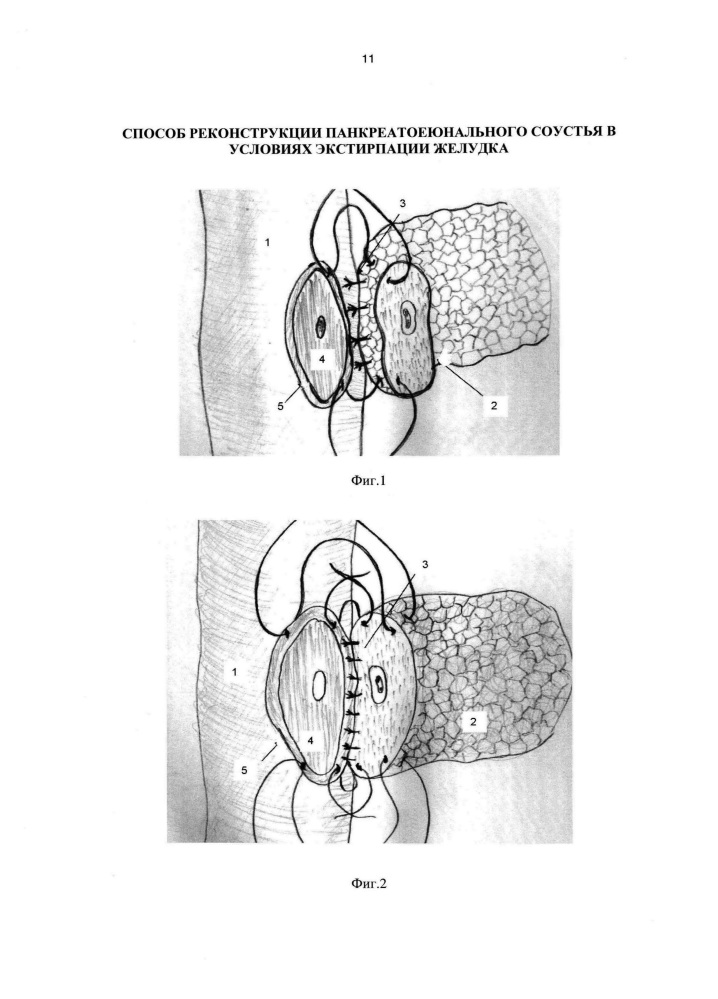 Способ реконструкции панкреатоеюнального соустья в условиях экстирпации желудка (патент 2641167)