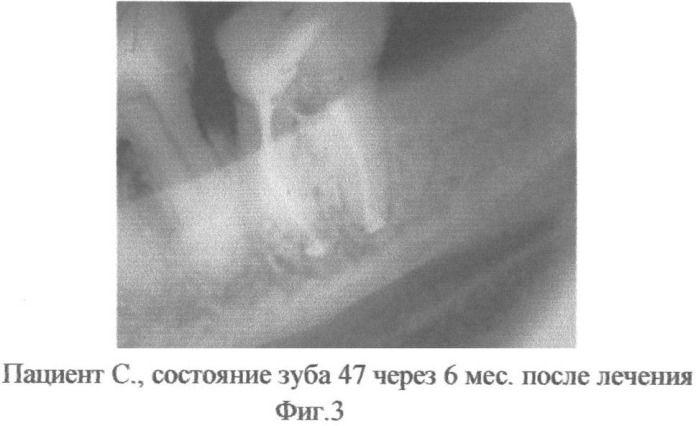 Способ лечения перфорации дна полости зуба (патент 2345732)