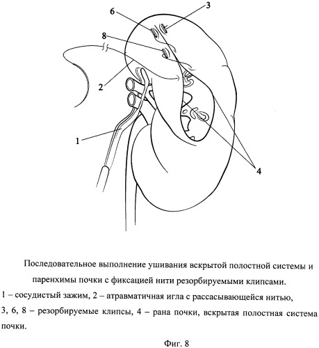 Способ одномоментного закрытия раны и полостной системы почки при лапароскопической резекции (патент 2532942)