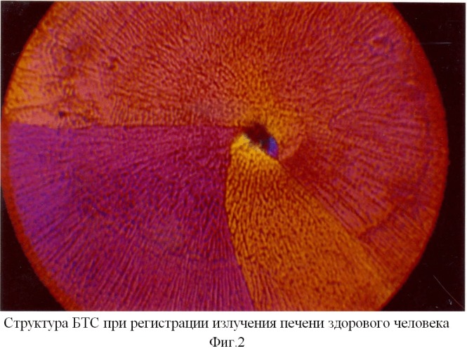 Способ экспресс-диагностики структурных изменений в печени при хроническом вирусном гепатите в (патент 2377948)