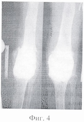 Способ замещения обширных дефектов мыщелков бедренной и большеберцовой костей при ревизионном эндопротезировании коленного сустава (патент 2355324)