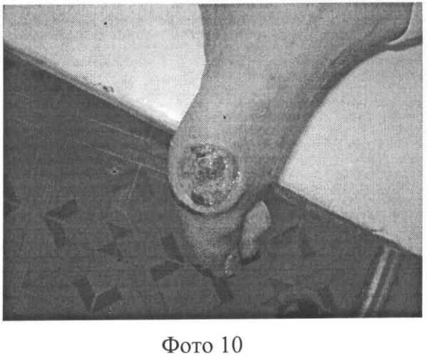 Способ лечения нейропатических трофических язв при синдроме диабетической стопы (патент 2549459)