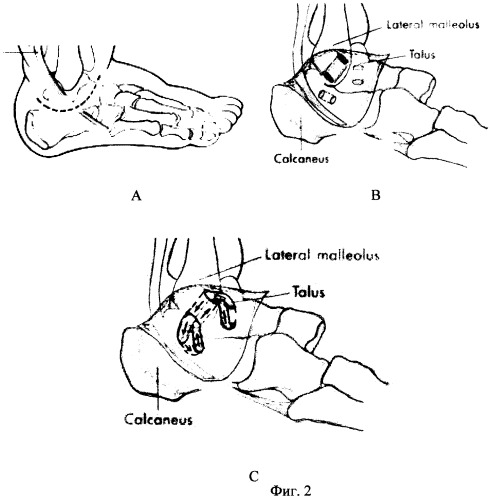 Способ аутопластики малоберцовых связок голеностопного сустава сухожилием полусухожильной мышцы бедра (патент 2257864)