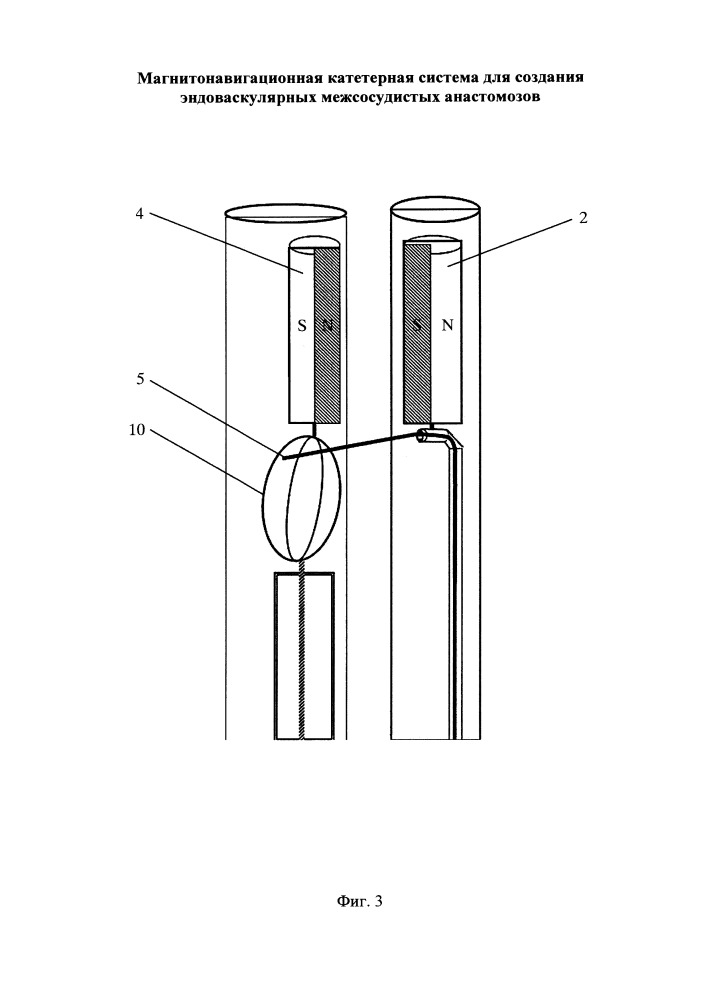 Магнитонавигационная катетерная система для создания эндоваскулярных межсосудистых анастомозов (патент 2662414)