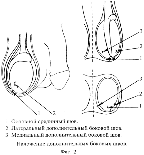 Способ профилактики заворота яичка (патент 2561298)