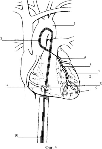 Коронарный катетер (патент 2355435)