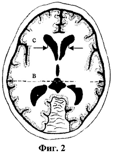Способ прогнозирования дислокации головного мозга при его компрессии (патент 2433782)