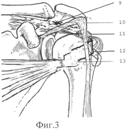 Способ оперативного лечения застарелого переднего вывиха плеча (патент 2332950)