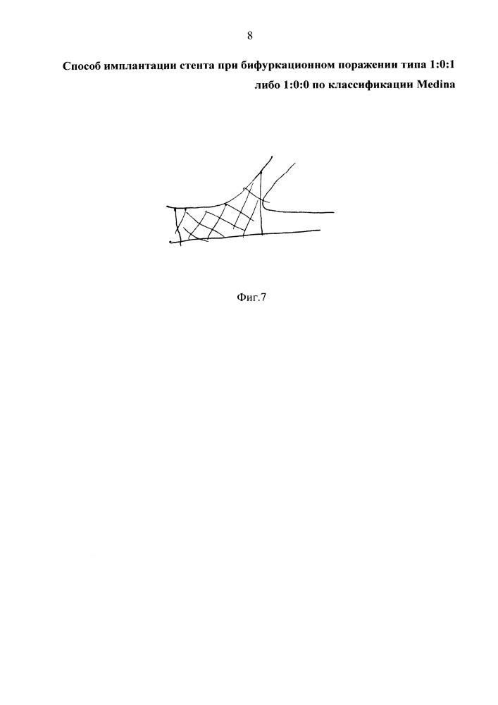 Способ имплантации стента при бифуркационном поражении типа 1:0:1 либо 1:0:0 по классификации medina (патент 2664614)