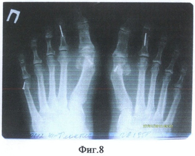 Способ межфалангового артродеза после коррекции ригидной молоткообразной деформации средних пальцев стопы (патент 2487683)