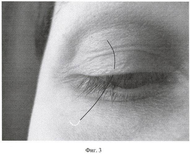 Способ имплантации ресниц (его варианты) (патент 2446751)