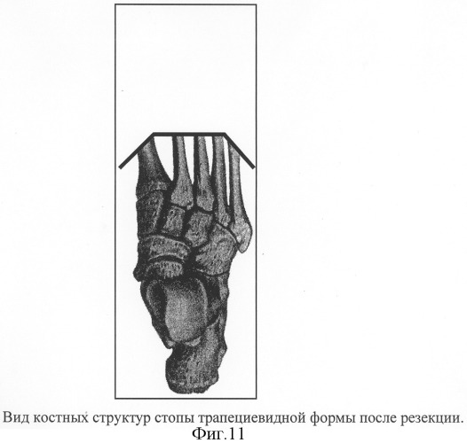 Способ формирования культи стопы (патент 2308244)