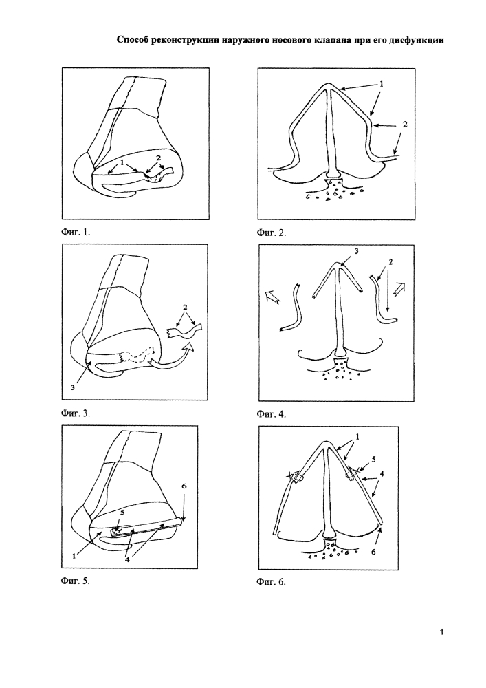 Способ реконструкции наружного носового клапана при его дисфункции (патент 2627351)