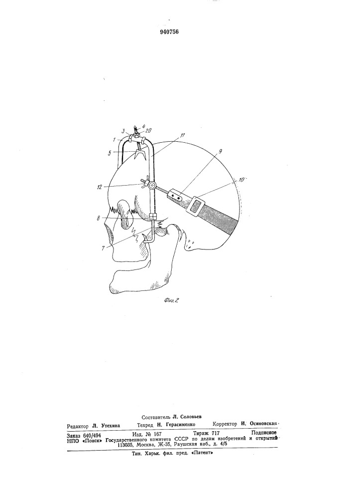Устройство для лечения переломов костей лицевого черепа (патент 940756)