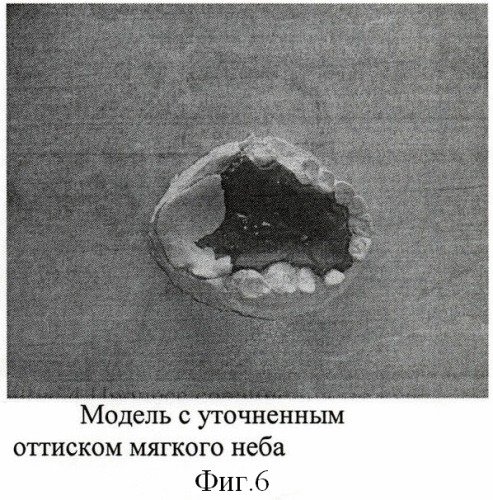 Способ изготовления разборной модели для протезов мягкого неба (патент 2406464)