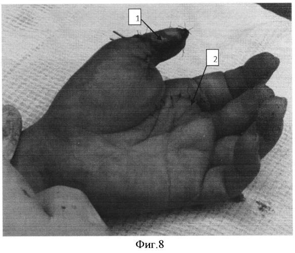 Способ восстановления утраченного первого пальца кисти (патент 2550935)