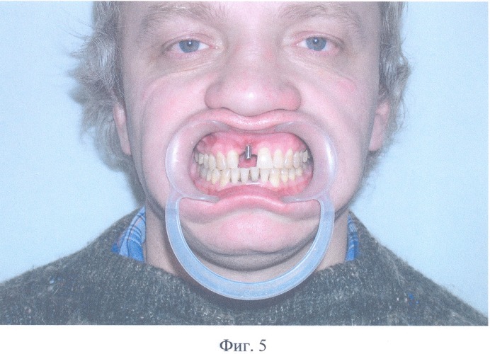 Зубной протез с опорой на внутрикостные имплантаты (патент 2326621)