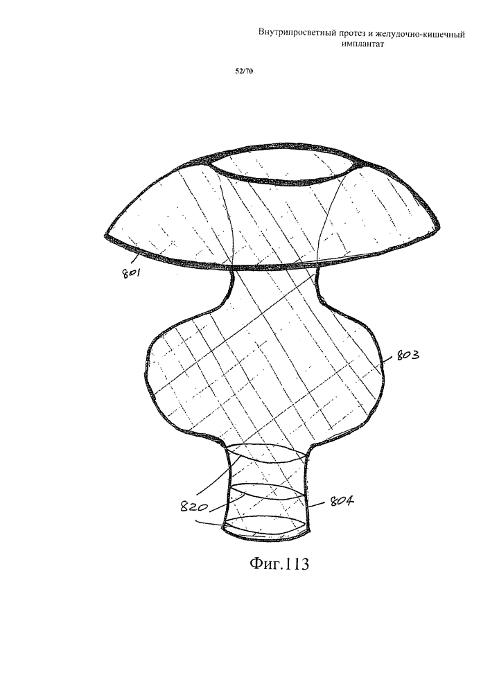 Внутрипросветный протез и желудочно-кишечный имплантат (патент 2626885)