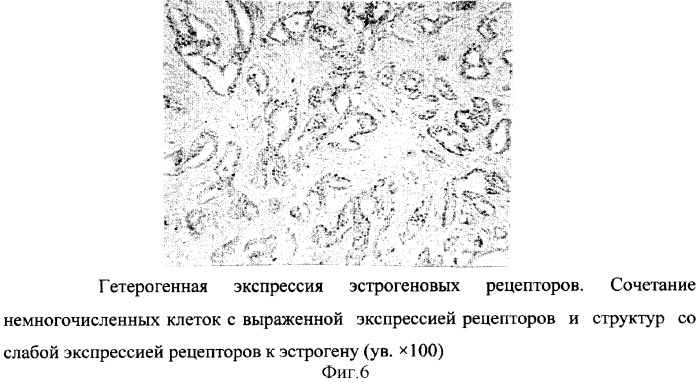 Способ прогнозирования течения заболевания раком молочной железы (патент 2300111)