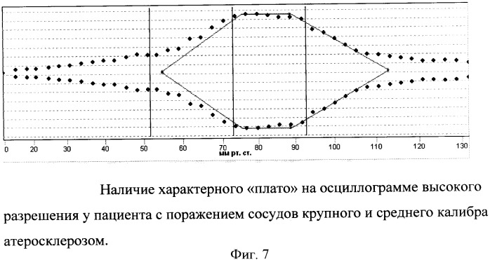 Способ определения артериального давления, параметров гемодинамики и состояния сосудистой стенки с использованием осциллометрии высокого разрешения (патент 2360596)