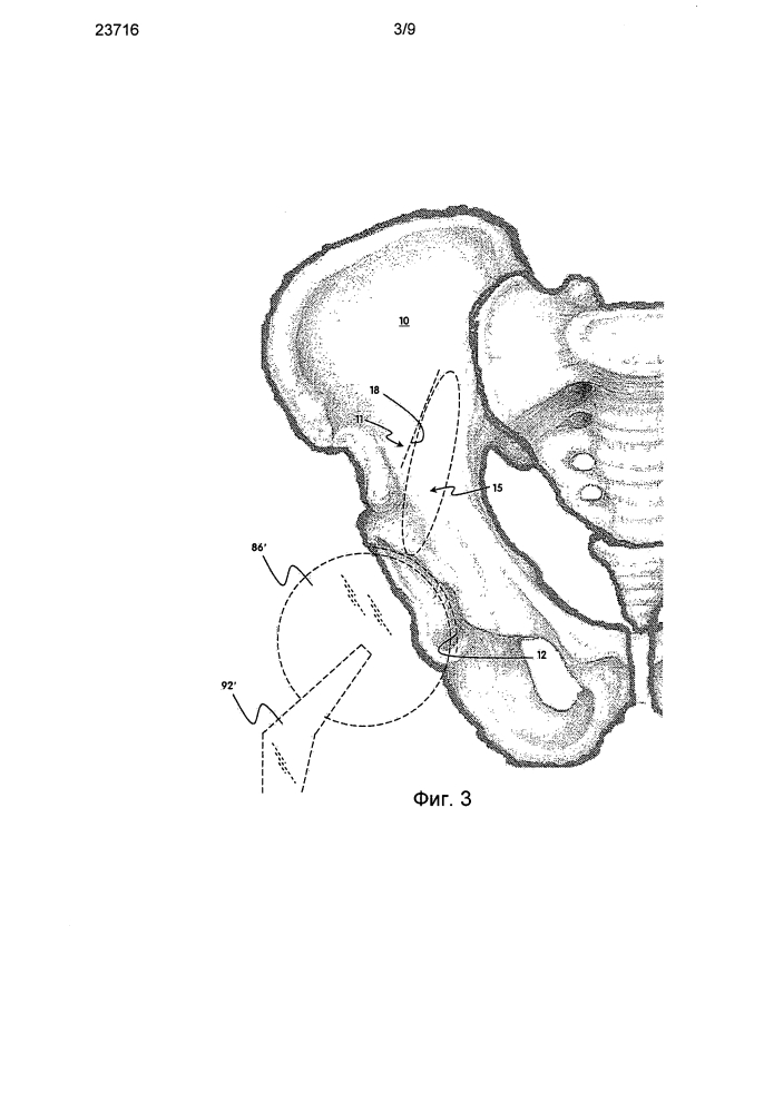 Способ и устройство для артропластики вертлужной впадины (патент 2596717)