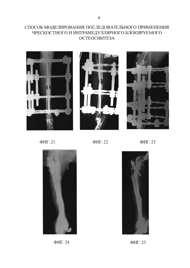 Способ моделирования последовательного применения чрескостного и интрамедуллярного блокируемого остеосинтеза (патент 2593583)