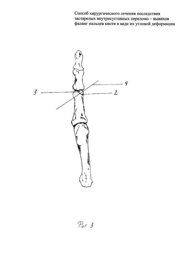 Способ хирургического лечения последствия застарелых внутрисуставных переломо-вывихов фаланг пальцев кисти в виде их угловой деформации (патент 2612588)