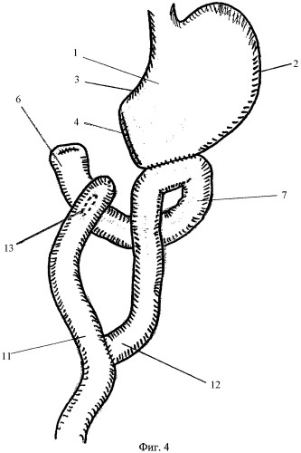 Способ выключения двенадцатиперстной кишки при хронической дуоденальной непроходимости (патент 2404716)