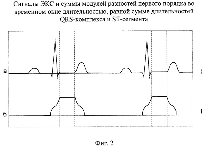 Способ выделения st-сегмента электрокардиосигнала в реальном времени и устройство для его осуществления (патент 2261653)