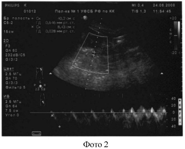 Способ оценки венозного кровотока по магистральным почечным венам (патент 2373856)