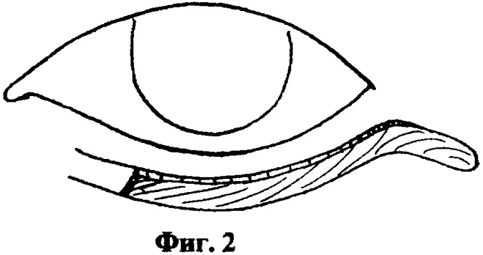 Способ хирургического лечения заворота нижнего века (патент 2342917)