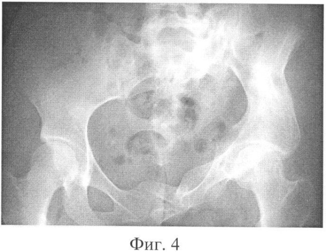 Способ реконструкции таза при стабильном, неправильно сросшемся переломе (патент 2349277)