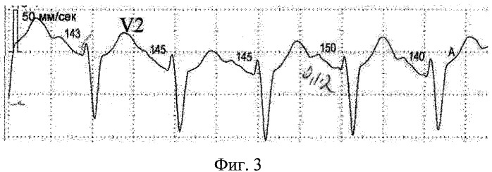 Способ диагностики внутрипредсердной блокады i степени у лиц молодого возраста с тахикардией (патент 2485882)