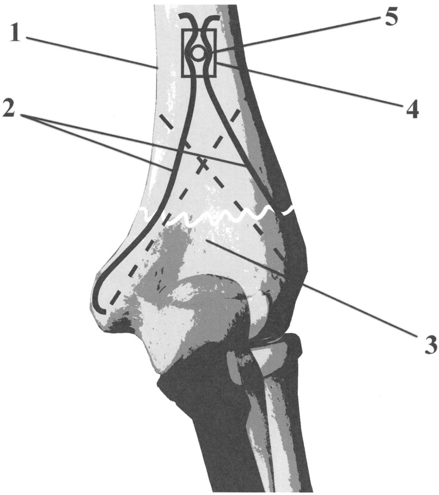 Способ упруго-напряженного остеосинтеза дистального отдела плечевой кости (патент 2637110)