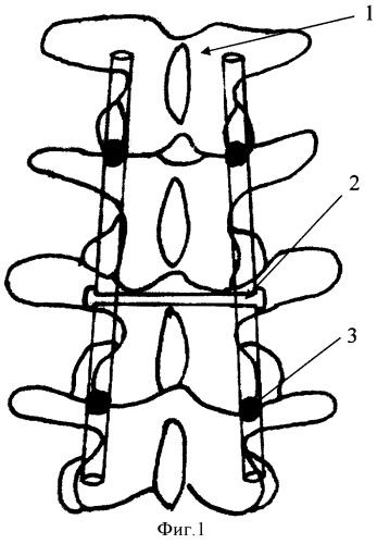 Способ лечения множественных переломов позвоночника у детей (патент 2370236)