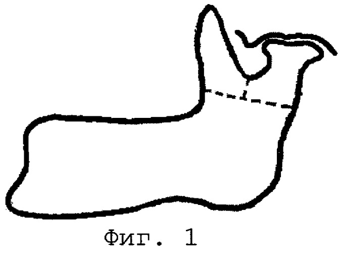 Способ устранения анкилозирующих поражений височно-нижнечелюстного сустава и недоразвития нижней челюсти (патент 2289341)