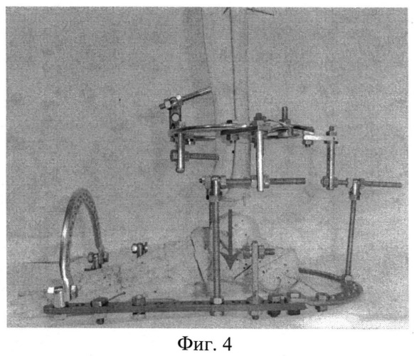 Способ остеосинтеза аппаратом орто-сув для устранения вывихов в голеностопном суставе (патент 2547798)