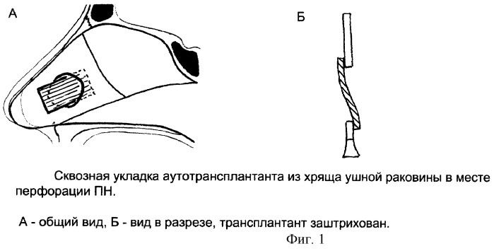 Способ пластического закрытия субтотальных перфораций перегородки носа у детей (патент 2246910)