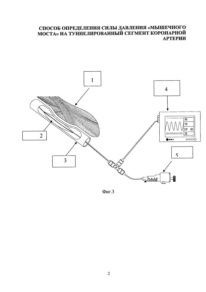 Способ определения силы давления "мышечного моста" на туннелированный сегмент коронарной артерии (патент 2599196)