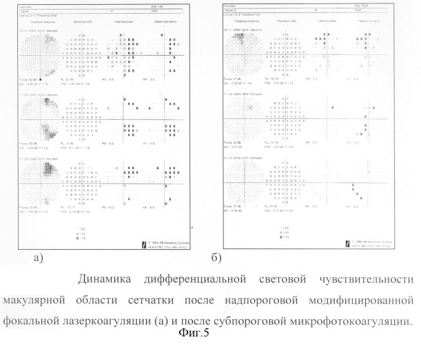 Способ модифицированной субпороговой панмакулярной микрофотокоагуляции сетчатки при диабетическом макулярном отёке (патент 2308920)