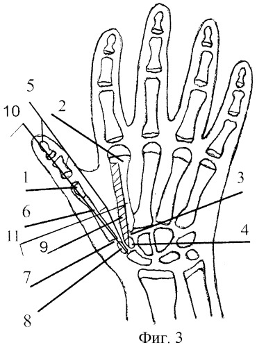 Способ лечения врожденной гипоплазии первого пальца кисти (патент 2297190)