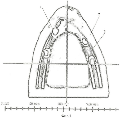 Способ моделирования повреждающего действия ионизирующего излучения на твердые ткани зуба человека (патент 2462282)