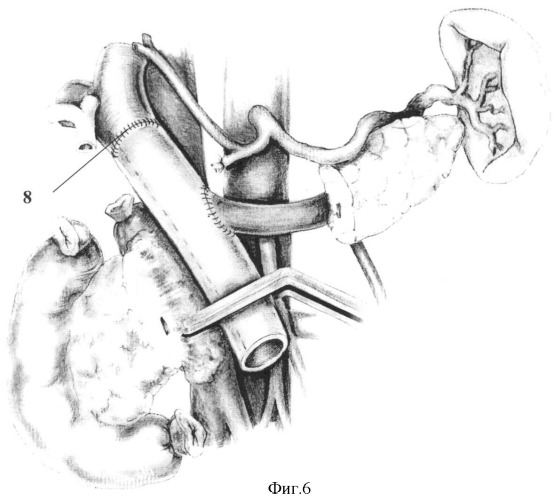 Способ панкреатодуоденальной резекции при местнораспространенном раке периампулярной области с обширной опухолевой инвазией магистральных вен мезентерико-портальной системы (патент 2336831)